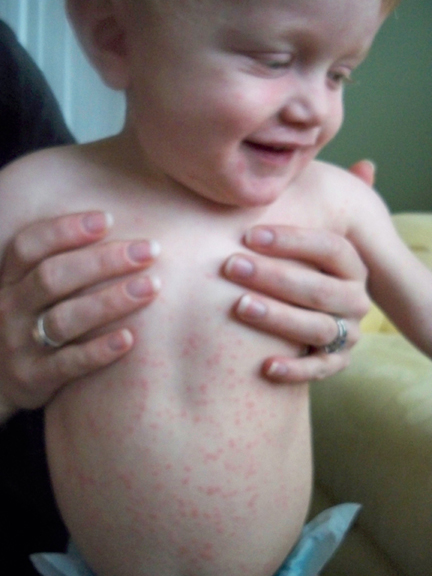 How do you know if your baby is allergic to antibiotics