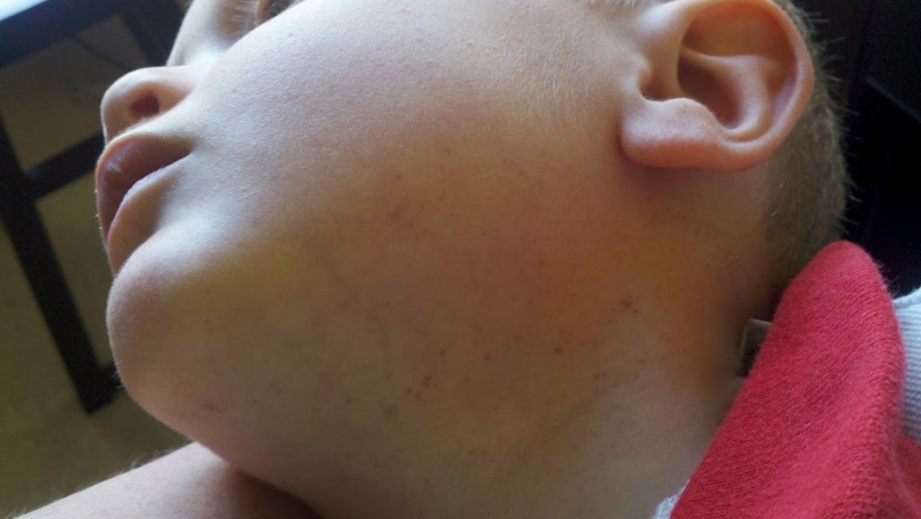 dotted red rash after crying or coughing petichia